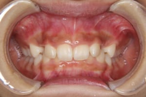 前歯の舌側傾斜、過蓋咬合、犬歯の口蓋側転位
